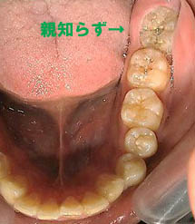 親知らずは抜かなきゃいけない 等々力 歯医者 デンタルオフィス等々力 夜9時まで診療の歯科